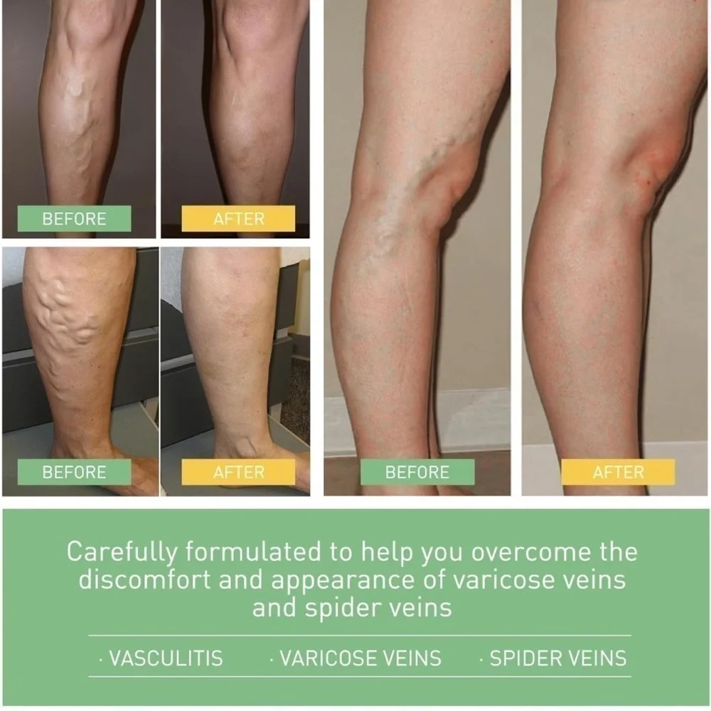 Varicose Veins Cream - Green Nourishing Leg Gel (50g) Lot Of 3 NEW